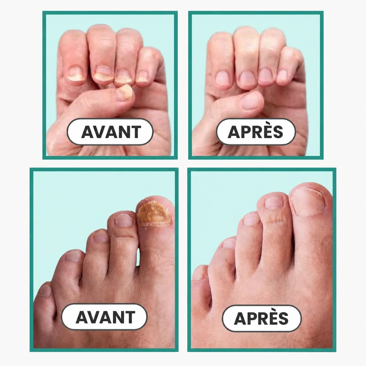 Appareil Lumière Bleue Anti-Mycose des Ongles