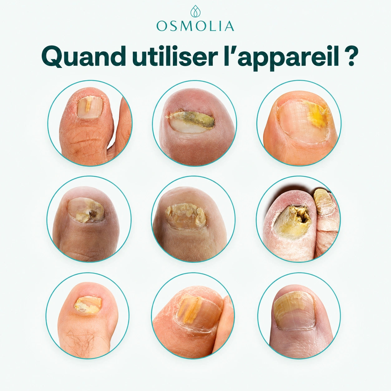 Appareil Lumière Bleue Anti-Mycose des Ongles