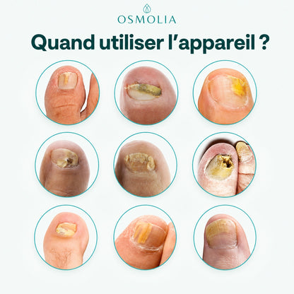Appareil Lumière Bleue Anti-Mycose des Ongles